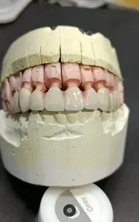 نیاز به پرسلن گذار دندانسازی  (پودر گذار )