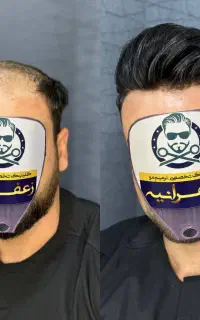 پروتزموپرپشتی مو بدون عمل و دردوخونریزی باضمانت