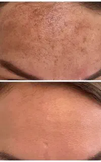 محصولات بیوممتیک ، پنکیک لاکچری کوئیین ، کرم بینی