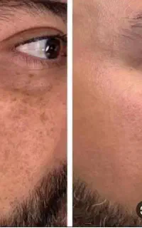 لیزر روشن کننده پوست پاک کردن تتو و کک ومک