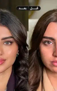 تزریق ژل و بوتاکس مزو ژل