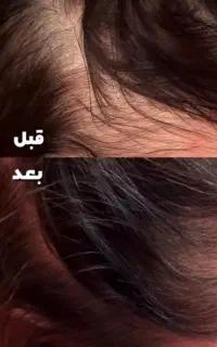 قطع ریزش مو و افزایش رشد ‌رشدی ابرو و ریش وسبیل