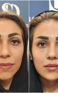 فیلر گونه،لب،چانه،بوتاکس،جوانساز