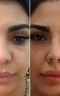 پلاسما کوچیک کردن بینی از بین بردن جای زخم