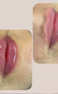 تزریق فیلر، جوانساز،بوتاکس توسط پزشک/ لیفت صورت