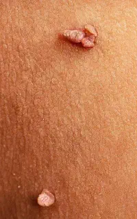 درمان اصولی و ریشه ای زگیل و تبخال