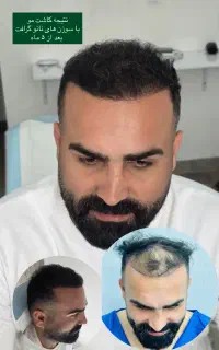 کاشت مو شیراز و کاشت میکروگرافت ابرو تهران در رشت