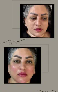 تزریق ژل و بوتاکس (خانوما و آقایون)