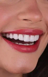 ایمپلنت در تبریز روکش ارتودنسی کامپوزیت