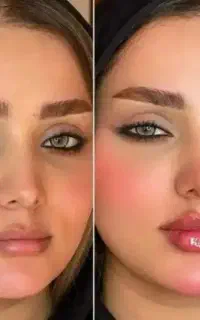 آموزش ژل و بوتاکس و مزو