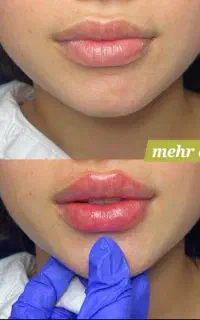لیفت و کانتورینگ فول فیس فیلر و بوتاکس لاغری