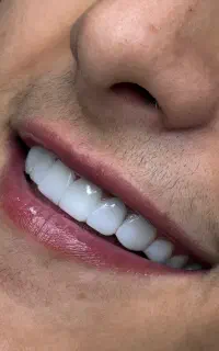 زیباترین کامپوزیت بدون هیچ پرداخت اولیه