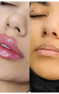 ژل بوتاکس فیلر بادی مزو