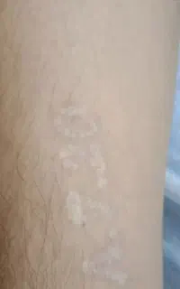 پاک کردن تتو با لیزر زیر نظر پزشک