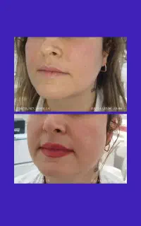 جوانسازی قوی بدون مواد