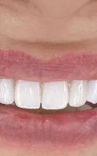 تخفیف ویژه 50درصدی ایمپلنت دندان12تومن