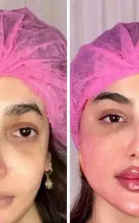 ژل،بوتاکس،فیلربادی باسن بیکینی،پی ارپی زاویه سازی