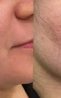 درمان قطعی اسکار پوستی یک دوره بدون درد و خون ریزی