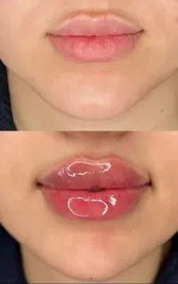 تخفیفات ژل وبوتاکس، فیلربادی ویژه کلینیک