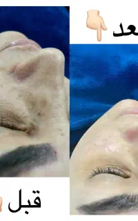 تخفیفات ما رواز دست ندیدن چند درجه پوست روشن تر کن