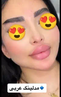 خدمات تخصصی فیلر صورت برای خانم  ها