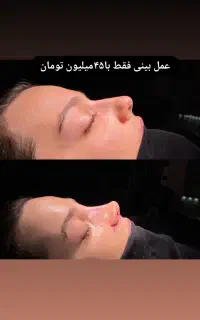عمل بینی فقط با۴۵میلیون