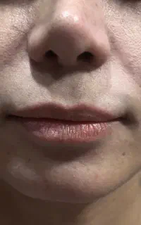 تزریق فیلر و بوتاکس