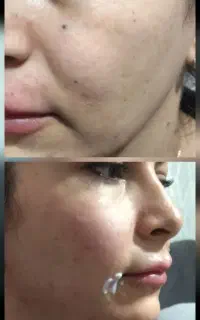 تزریق ژل و بوتاکس