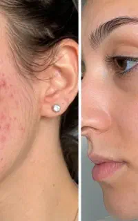 خداحافظی با آکنه با بیوممتیک اصل