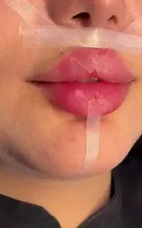 تخفیف ویژه فیلر/ژل/بوتاکس690