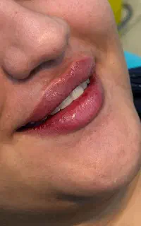 تزریقات زیبایی صورت و بدن