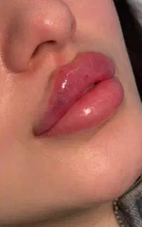 آموزش و خدمات ژل و بوتاکس ،مزوجوانساز
