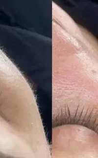 خدمات درماپلنینگ همکاری درسالن ها و کلینیک زیبایی
