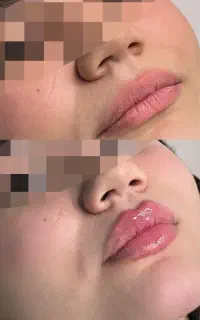 تزریق فیلر و بوتاکس ، لیزر و سفید کننده
