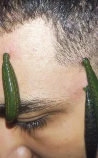 حجامت تخصصی اصفهان فصد پیشانی زالو غلظت واریس دیسک