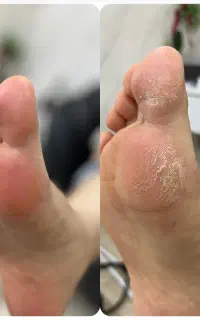 موخوره گیری -پدیکور کفسابی کف پا