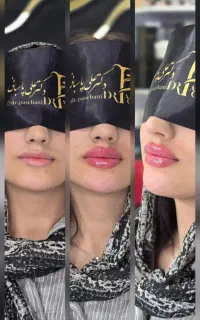 تزریق ژل وبوتاکس و لیزر موی زایدولیزر پاک کردن تتو