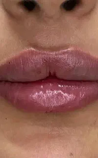 جشنواره ژل بوتاکس فیلر پی ار پی