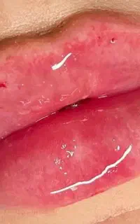 فیلر و بوتاکس