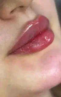 فیلر لب/گونه/چانه/بوتاکس