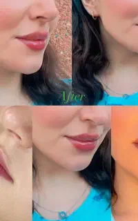بوتاکس/فیلربادی/ژل لب/زاویه فک/پی آر پی مو و ابرو