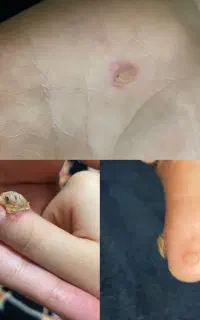 زگیل /ضمانت داده میشه