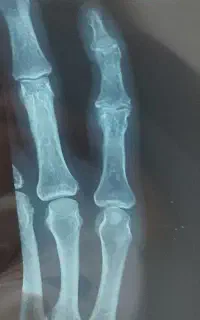 شکسته بندی کریمی