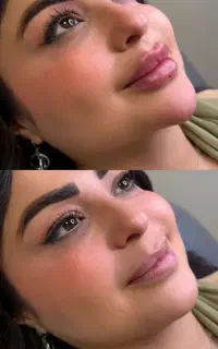 زیبایی ژل بوتاکس