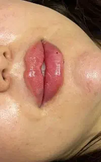 تزریق فیلر و بوتاکس