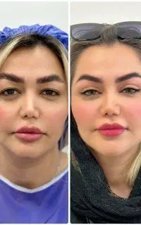 جراحی پلک فقط با ۱۰۹۰۰