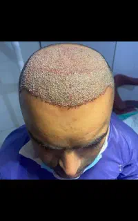 فرصت استثنایی کاشتمو و ابرو به مدت محدود