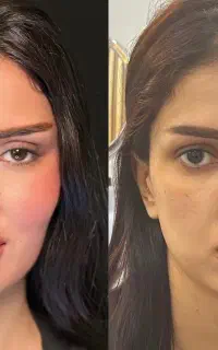استخوانی یا پر کردن چهره چربیسوز غبغب تک جلسه
