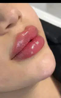 تزریق ژل و بوتاکس و مزوژل با قیمت استثنایی