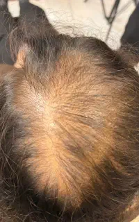مزوتراپی و PRP ریزش مو بانوان توسط پزشک